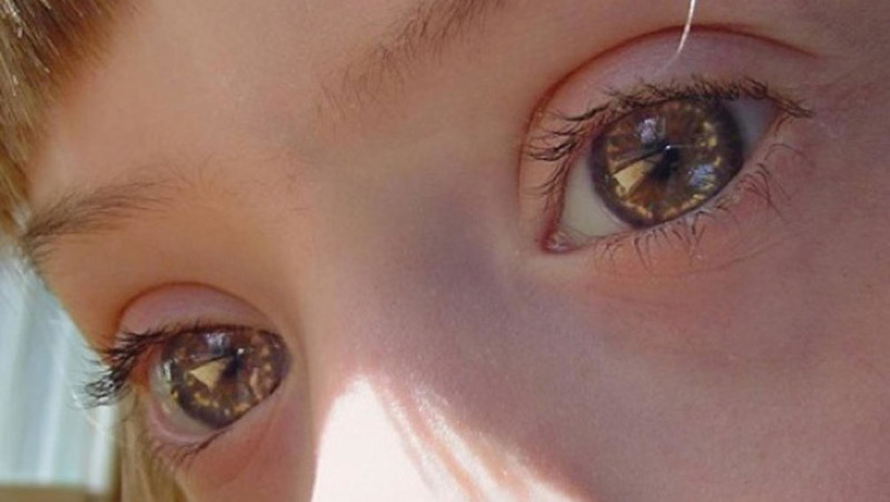 Occhi di una bambina con sindrome di down